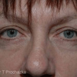 After Blepharoplasty