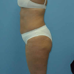 After liposuction