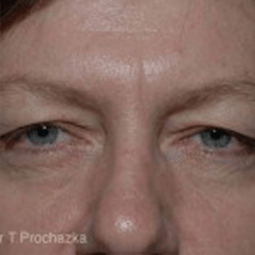 before blepharoplasty