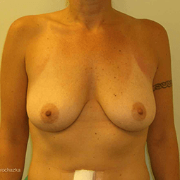 Before breast augmentation-1