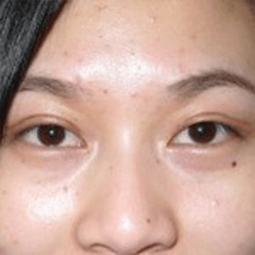 after blepharoplasty