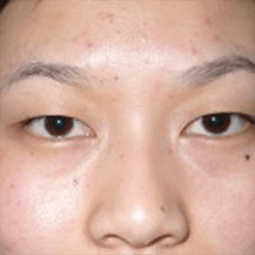 Before Plepharoplasty