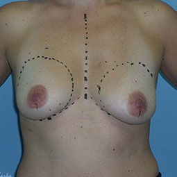 Before Breast Augmentation 3
