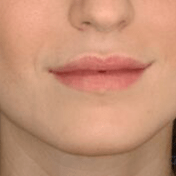 After dermal fillers